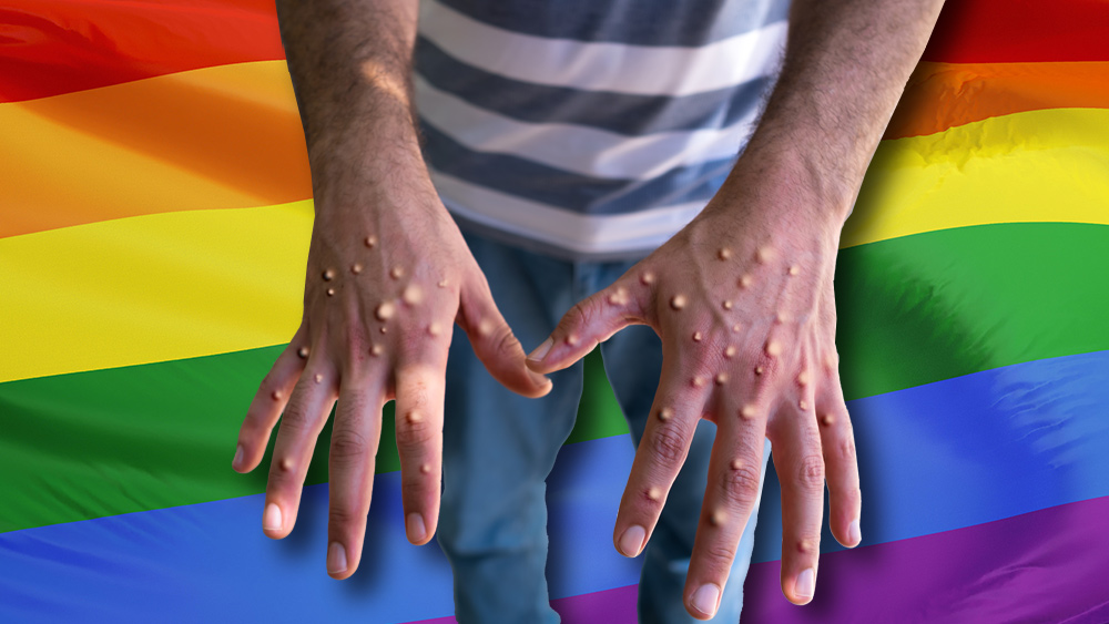 Image: If gays didn’t receive special treatment by society, monkeypox would be a non-issue
